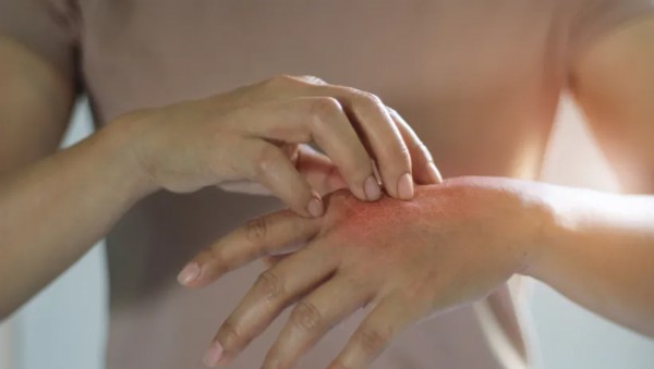 Uzmanlardan kış egzaması uyarısı: Bu alışkanlığı bırakın